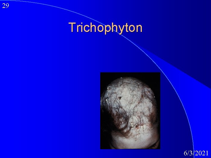 29 Trichophyton 6/3/2021 