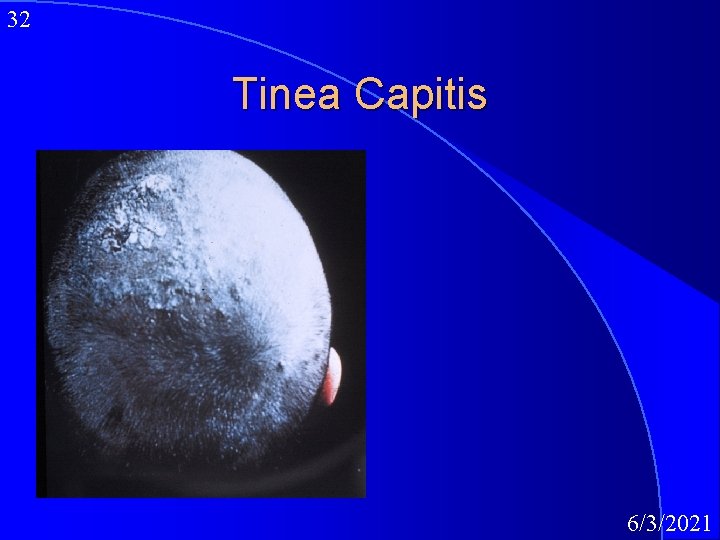 32 Tinea Capitis 6/3/2021 