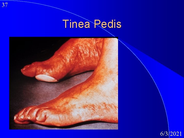 37 Tinea Pedis 6/3/2021 