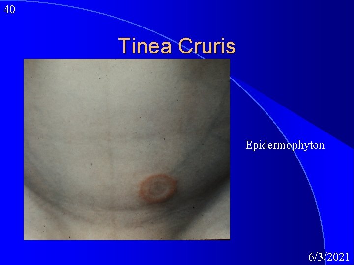 40 Tinea Cruris Epidermophyton 6/3/2021 