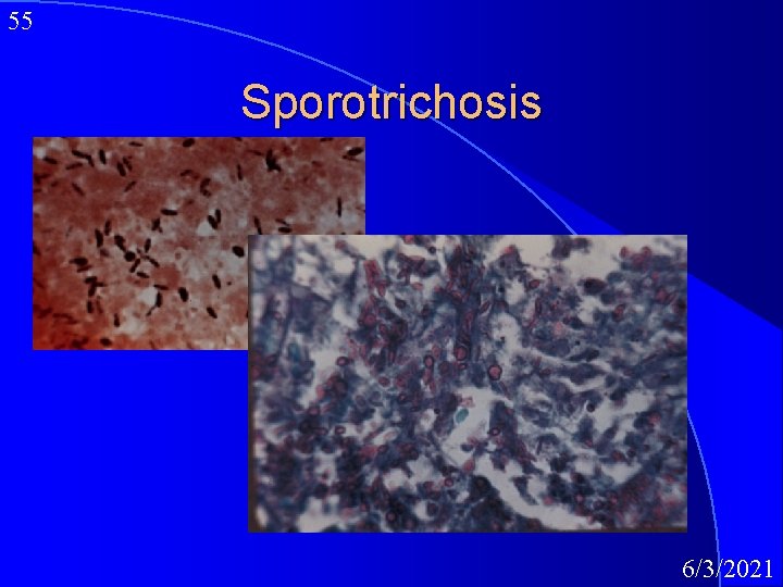 55 Sporotrichosis 6/3/2021 