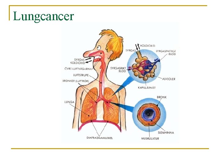 Lungcancer 