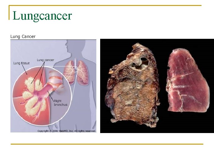 Lungcancer 