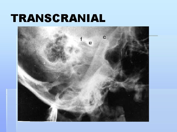 TRANSCRANIAL 