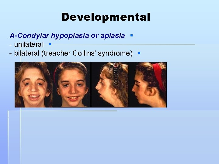 Developmental A-Condylar hypoplasia or aplasia § - unilateral § - bilateral (treacher Collins' syndrome)