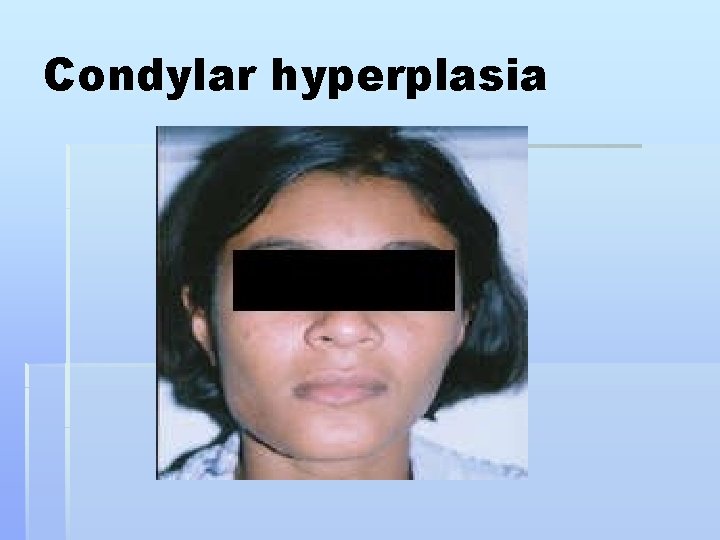 Condylar hyperplasia 