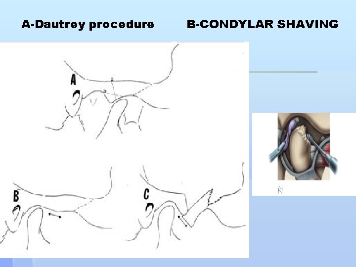 A-Dautrey procedure B-CONDYLAR SHAVING 