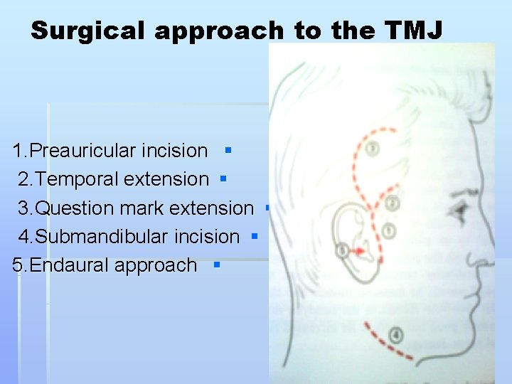 Surgical approach to the TMJ 1. Preauricular incision § 2. Temporal extension § 3.