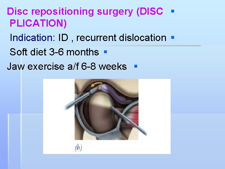 Disc repositioning surgery (DISC § PLICATION) Indication: ID , recurrent dislocation § Soft diet