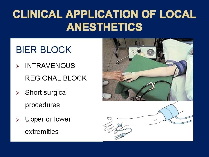 CLINICAL APPLICATION OF LOCAL ANESTHETICS BIER BLOCK Ø INTRAVENOUS REGIONAL BLOCK Ø Short surgical