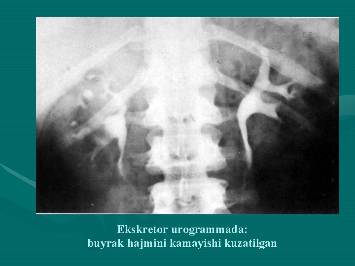 Ekskretor urogrammada: buyrak hajmini kamayishi kuzatilgan 