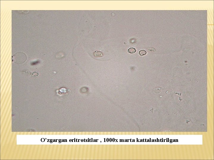 O’zgargan eritrotsitlar , 1000 х marta kattalashtirilgan 