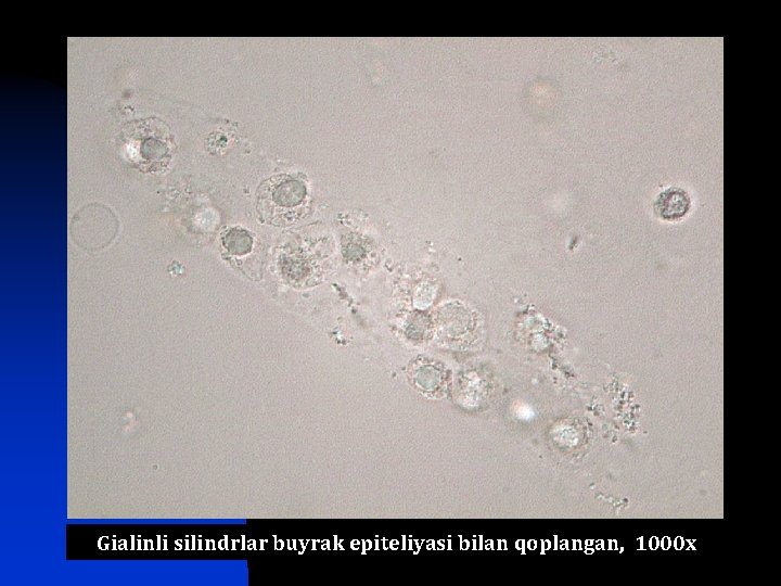 Gialinli silindrlar buyrak epiteliyasi bilan qoplangan, 1000 х 