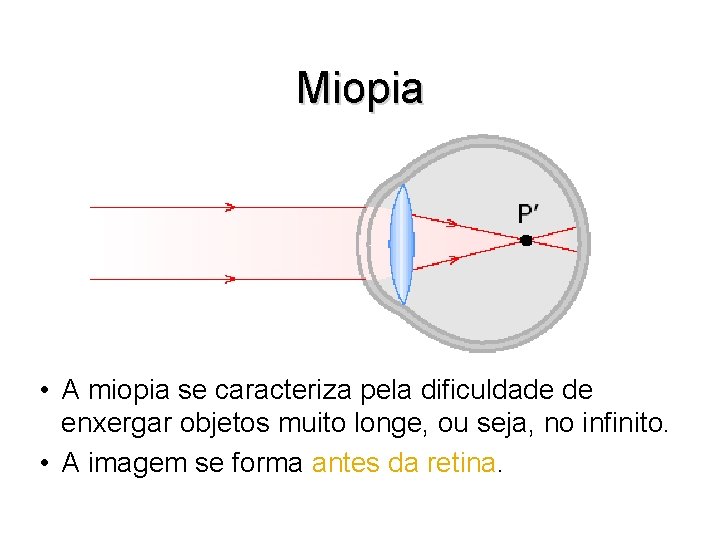 Miopia • A miopia se caracteriza pela dificuldade de enxergar objetos muito longe, ou