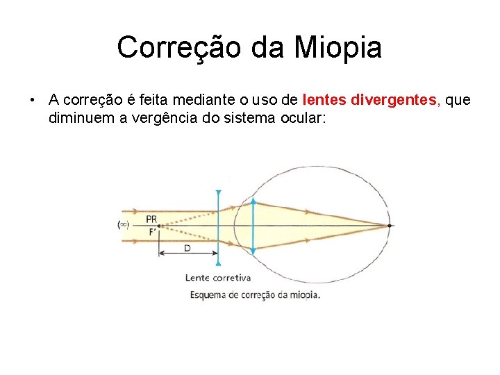 Correção da Miopia • A correção é feita mediante o uso de lentes divergentes,