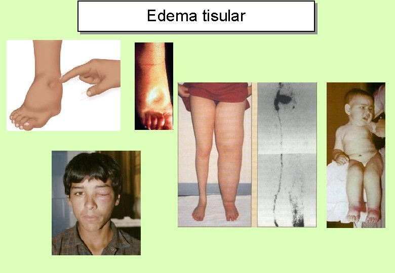 Edema tisular 