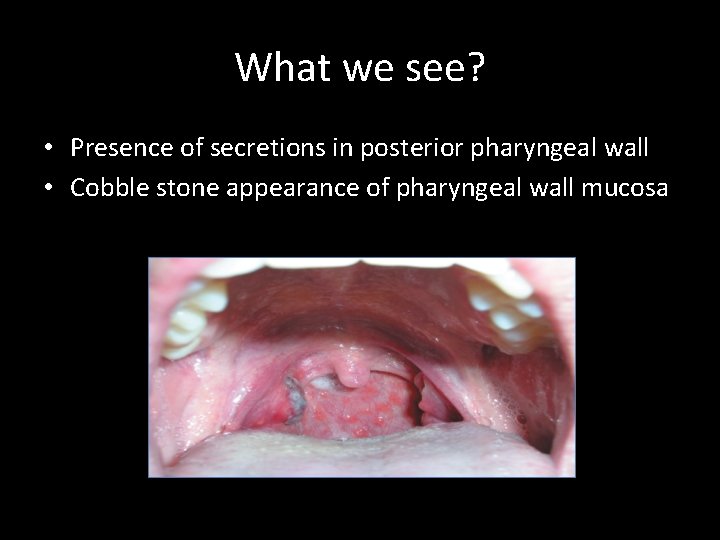 What we see? • Presence of secretions in posterior pharyngeal wall • Cobble stone