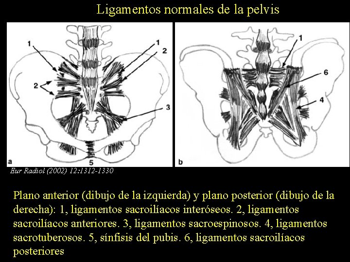 Ligamentos normales de la pelvis Eur Radiol (2002) 12: 1312 -1330 Plano anterior (dibujo