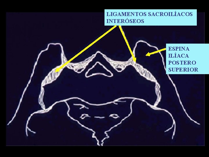 LIGAMENTOS SACROILÍACOS INTERÓSEOS ESPINA ILÍACA POSTERO SUPERIOR 