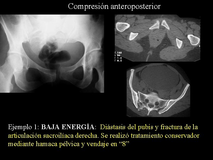 Compresión anteroposterior Ejemplo 1: BAJA ENERGÍA: Diástasis del pubis y fractura de la articulación