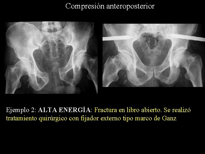 Compresión anteroposterior Ejemplo 2: ALTA ENERGÍA: Fractura en libro abierto. Se realizó tratamiento quirúrgico