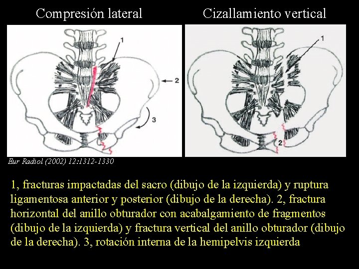 Compresión lateral Cizallamiento vertical Eur Radiol (2002) 12: 1312 -1330 1, fracturas impactadas del