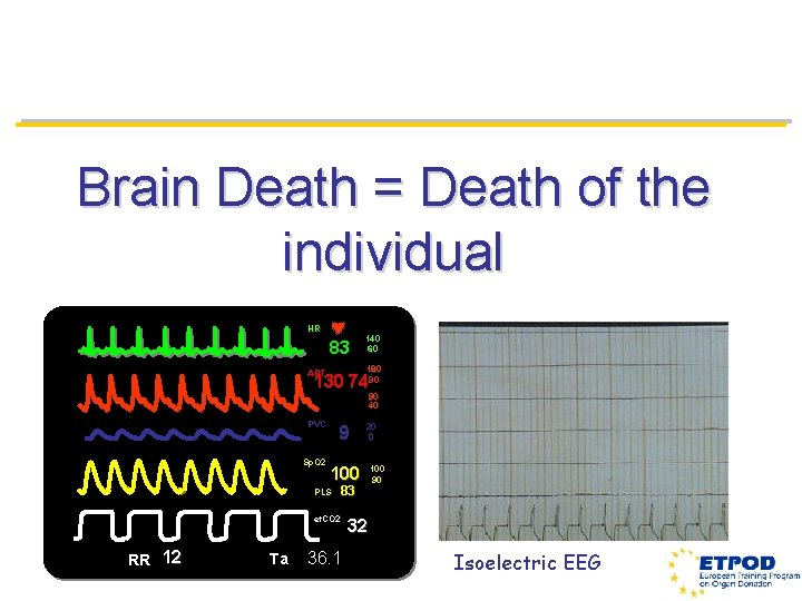 Brain Death = Death of the individual HR 83 140 60 180 90 ART