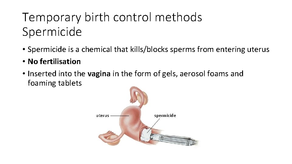 Temporary birth control methods Spermicide • Spermicide is a chemical that kills/blocks sperms from