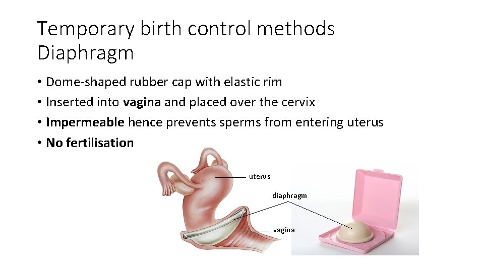 Temporary birth control methods Diaphragm • Dome-shaped rubber cap with elastic rim • Inserted