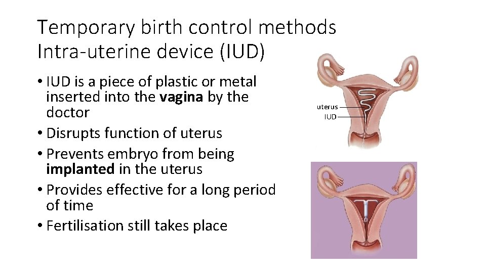 Temporary birth control methods Intra-uterine device (IUD) • IUD is a piece of plastic