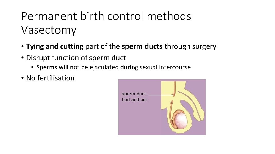 Permanent birth control methods Vasectomy • Tying and cutting part of the sperm ducts
