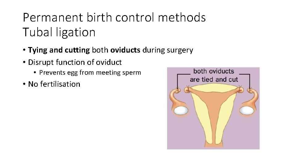 Permanent birth control methods Tubal ligation • Tying and cutting both oviducts during surgery