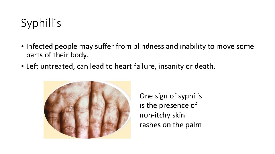 Syphillis • Infected people may suffer from blindness and inability to move some parts
