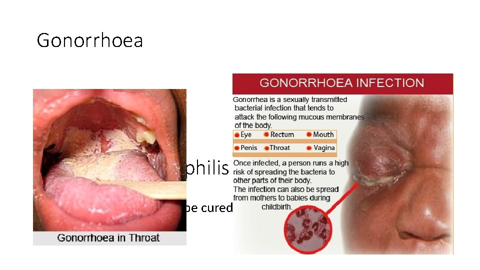 Gonorrhoea Treatment for syphilis and gonorrhoea • These bacterial STIs can be cured when