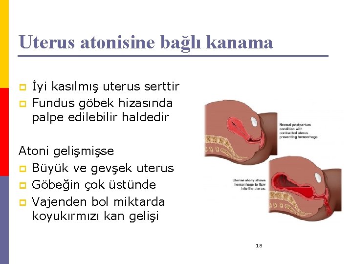 Uterus atonisine bağlı kanama p p İyi kasılmış uterus serttir Fundus göbek hizasında palpe