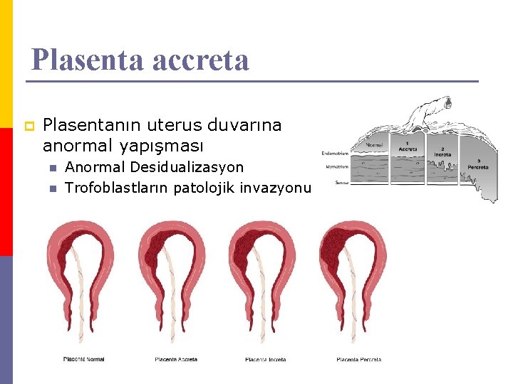 Plasenta accreta p Plasentanın uterus duvarına anormal yapışması n n Anormal Desidualizasyon Trofoblastların patolojik