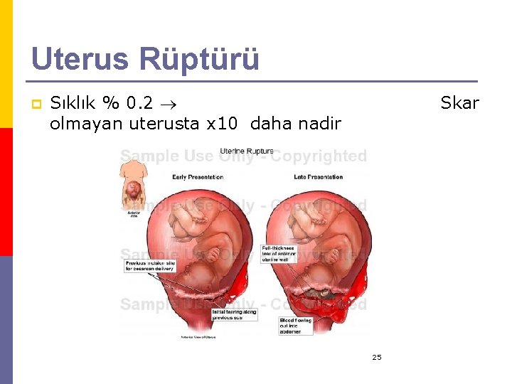 Uterus Rüptürü p Sıklık % 0. 2 olmayan uterusta x 10 daha nadir Skar