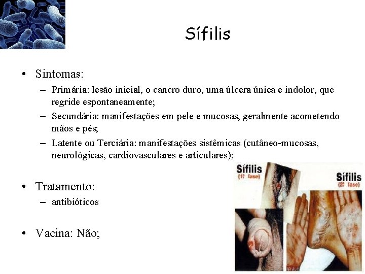 Sífilis • Sintomas: – Primária: lesão inicial, o cancro duro, uma úlcera única e