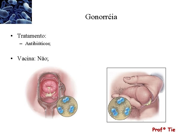 Gonorréia • Tratamento: – Antibióticos; • Vacina: Não; Profº Tie 
