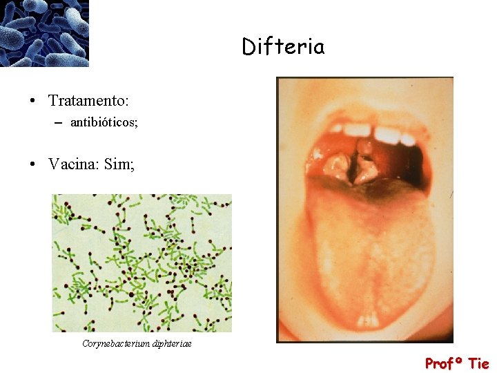 Difteria • Tratamento: – antibióticos; • Vacina: Sim; Corynebacterium diphteriae Profº Tie 
