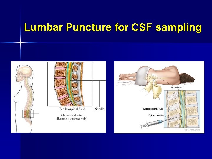 Lumbar Puncture for CSF sampling 