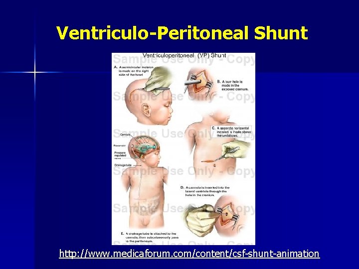 Ventriculo-Peritoneal Shunt http: //www. medicaforum. com/content/csf-shunt-animation 