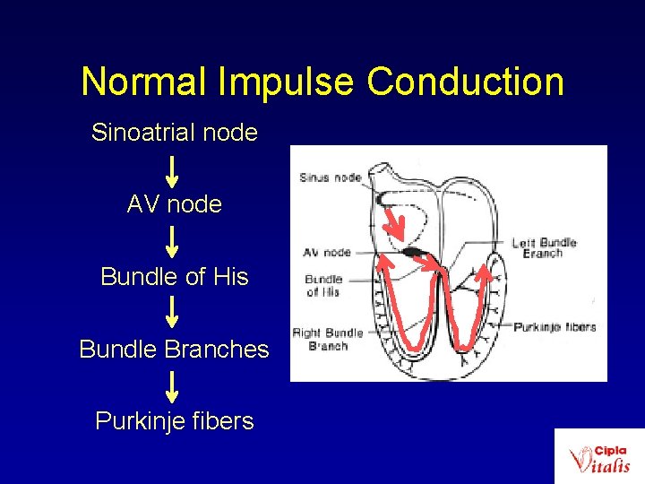 Normal Impulse Conduction Sinoatrial node AV node Bundle of His Bundle Branches Purkinje fibers