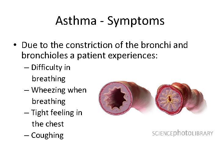Asthma - Symptoms • Due to the constriction of the bronchi and bronchioles a