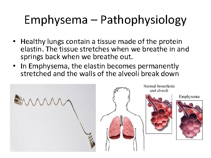 Emphysema – Pathophysiology • Healthy lungs contain a tissue made of the protein elastin.