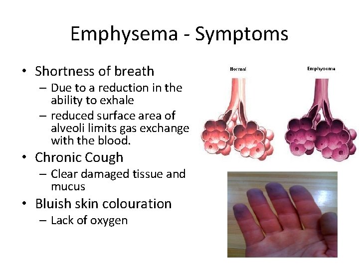 Emphysema - Symptoms • Shortness of breath – Due to a reduction in the