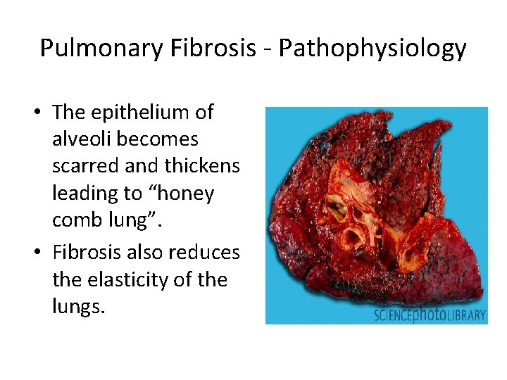 Pulmonary Fibrosis - Pathophysiology • The epithelium of alveoli becomes scarred and thickens leading