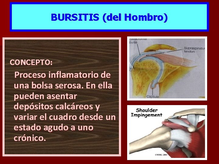 BURSITIS (del Hombro) CONCEPTO: Proceso inflamatorio de una bolsa serosa. En ella pueden asentar