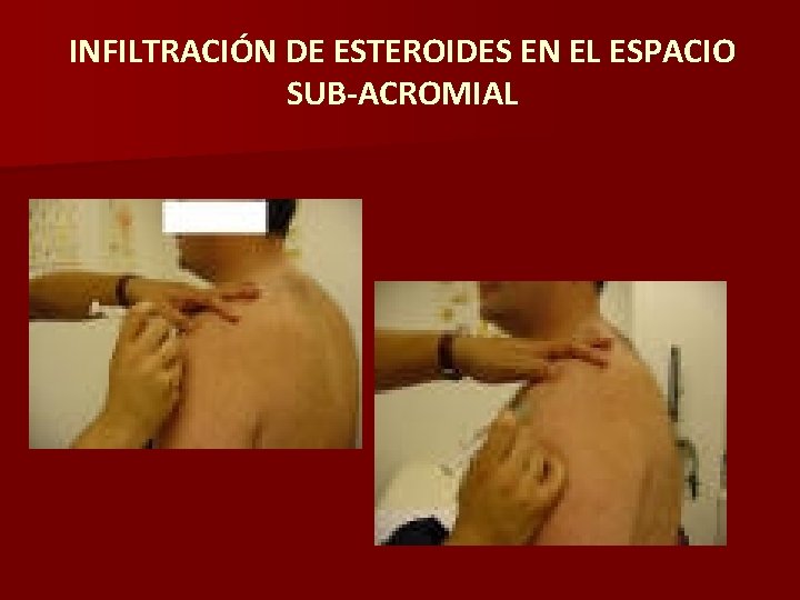INFILTRACIÓN DE ESTEROIDES EN EL ESPACIO SUB-ACROMIAL 