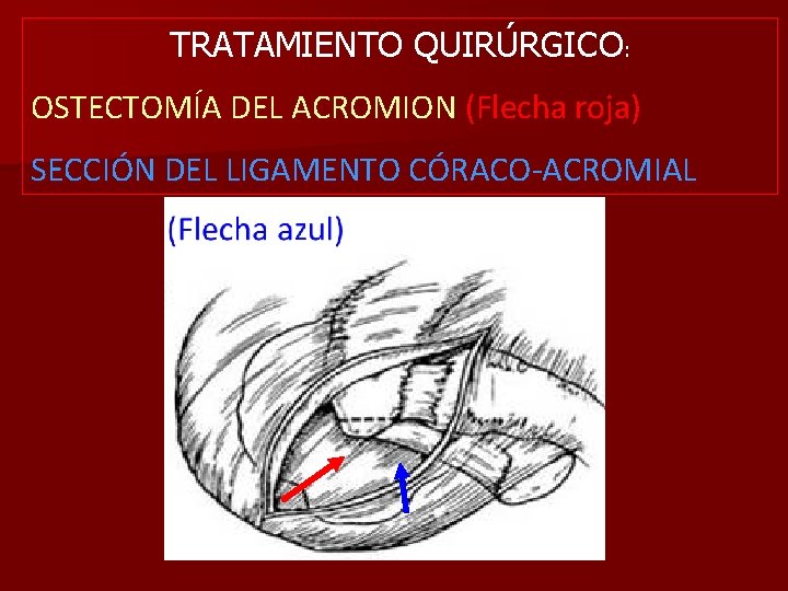 TRATAMIENTO QUIRÚRGICO: OSTECTOMÍA DEL ACROMION (Flecha roja) SECCIÓN DEL LIGAMENTO CÓRACO-ACROMIAL 
